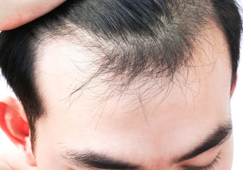 Understanding and Managing Stress-Related Hair Loss